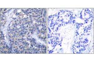 Immunohistochemistry analysis of paraffin-embedded human breast carcinoma tissue, using ZAP-70 (Ab-319) Antibody. (ZAP70 抗体  (AA 286-335))