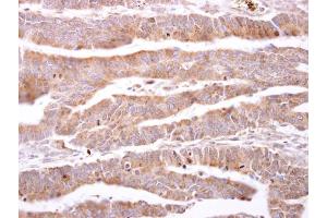IHC-P Image ILBP antibody detects ILBP protein at cytosol on human colon carcinoma by immunohistochemical analysis. (FABP6 抗体)