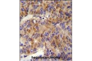 MIN Antibody (N-term) (ABIN654085 and ABIN2843973) immunohistochemistry analysis in formalin fixed and paraffin embedded human hepatocarcinoma followed by peroxidase conjugation of the secondary antibody and DAB staining.