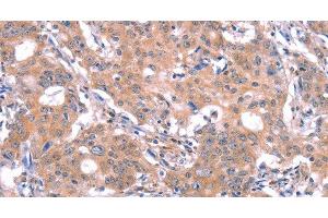Immunohistochemistry of paraffin-embedded Human gastric cancer using GABAA Receptor alpha1 Polyclonal Antibody at dilution of 1:30 (GABRA1 抗体)