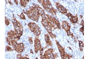 Formalin-fixed, paraffin-embedded human Breast Carcinoma stained with HER-2 Monospecific Mouse Monoclonal Antibody (ERBB2/3093). (ErbB2/Her2 抗体  (AA 311-462))