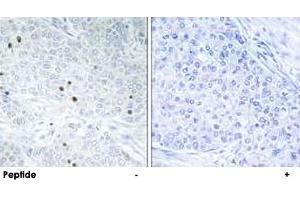 Immunohistochemistry analysis of paraffin-embedded human breast carcinoma tissue, using TP53INP2 polyclonal antibody . (TP53INP2 抗体)
