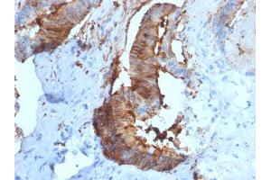 Formalin-fixed, paraffin-embedded human Renal Cell Carcinoma stained with Cathepsin D Mouse Monoclonal Antibody (CTSD/2781). (Cathepsin D 抗体  (AA 104-250))