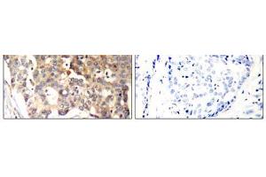 Immunohistochemical analysis of paraffin-embedded human breast carcinoma tissue, using SHP-1 (Ab-536) antibody (E021318). (SHP1 抗体)