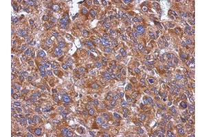 IHC-P Image Immunohistochemical analysis of paraffin-embedded human hepatoma, using CYP26A1 , antibody at 1:500 dilution.