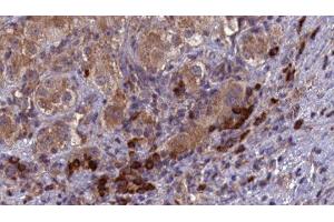 ABIN6277103 at 1/100 staining Human liver cancer tissue by IHC-P. (SPAM1 抗体  (Internal Region))