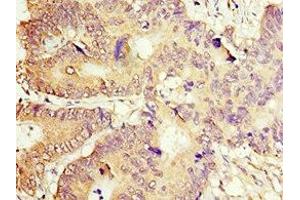 Immunohistochemistry of paraffin-embedded human colon cancer using ABIN7149378 at dilution of 1:100 (ACOT7 抗体  (AA 151-380))