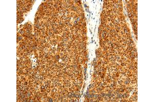Immunohistochemistry of Human liver cancer using DIABLO Polyclonal Antibody at dilution of 1:50