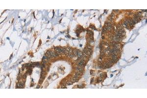 Immunohistochemistry of paraffin-embedded Human colon cancer tissue using RPS6KA2 Polyclonal Antibody at dilution 1:40 (RPS6KA2 抗体)