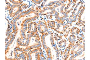 The image on the left is immunohistochemistry of paraffin-embedded Human thyroid cancer tissue using ABIN7192286(SCNN1A Antibody) at dilution 1/30, on the right is treated with synthetic peptide. (SCNN1A 抗体)