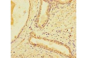 Immunohistochemistry of paraffin-embedded human prostate cancer using ABIN7171154 at dilution of 1:100 (SYT1 抗体  (AA 301-523))