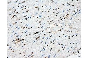 Immunohistochemical staining of paraffin-embedded Adenocarcinoma of ovary tissue using anti-NME4 mouse monoclonal antibody. (NME4 抗体)