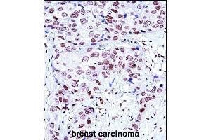 NCK1 Antibody (N-term) (ABIN657648 and ABIN2846643) immunohistochemistry analysis in formalin fixed and paraffin embedded human breast carcinoma followed by peroxidase conjugation of the secondary antibody and DAB staining. (NCK1 抗体  (N-Term))