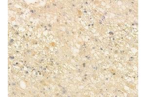 ABIN6260980 and ABIN6266518 at 1/100 staining human astrocytoma by IHC-P. (COX1 抗体  (C-Term))