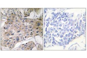 Immunohistochemistry analysis of paraffin-embedded human breast carcinoma tissue using COX7S/A2 antibody. (COX7S/A2 (N-Term) 抗体)