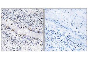 Immunohistochemistry analysis of paraffin-embedded human lung carcinoma tissue, using ZNF76 antibody. (ZNF76 抗体  (Internal Region))