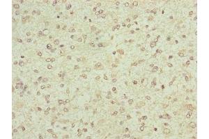 Immunohistochemistry of paraffin-embedded human glioma using ABIN7152447 at dilution of 1:100 (FBXO6 抗体  (AA 104-293))