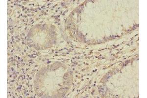 Immunohistochemistry of paraffin-embedded human colon cancer using ABIN7170966 at dilution of 1:100 (SAE1 抗体  (AA 1-346))