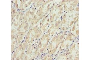 Immunohistochemistry of paraffin-embedded human gastric cancer using ABIN7151422 at dilution of 1:100 (EFHC1 抗体  (AA 391-640))