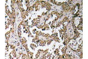 Immunohistochemical analysis of paraffin-embedded human lung cancer tissue using OR5H15 polyclonal antibody . (OR5H15 抗体)