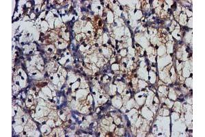 Immunohistochemical staining of paraffin-embedded Carcinoma of Human kidney tissue using anti-MGLL mouse monoclonal antibody. (MGLL 抗体)