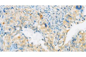 Immunohistochemistry of paraffin-embedded Human cervical cancer tissue using ARHGEF10 Polyclonal Antibody at dilution 1:45 (ARHGEF10 抗体)