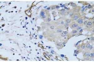 Immunohistochemistry of paraffin-embedded Human breast cancer using MCAM Polyclonal Antibody at dilution of 1:100 (40x lens). (MCAM 抗体)