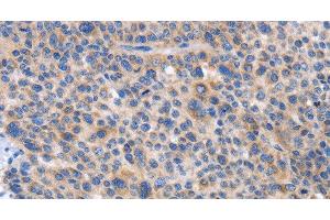 Immunohistochemistry of paraffin-embedded Human liver cancer tissue using CARD17 Polyclonal Antibody at dilution 1:50 (CARD17 抗体)