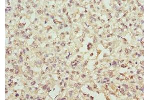 Immunohistochemistry of paraffin-embedded human melanoma using ABIN7143939 at dilution of 1:100 (SNCA 抗体  (AA 1-139))