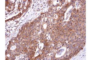IHC-P Image ETBR antibody [N1N2], N-term detects ETBR protein at cytosol on human colon carcinoma by immunohistochemical analysis.