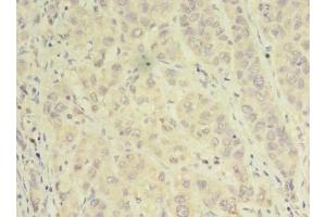 Immunohistochemistry of paraffin-embedded human liver cancer using ABIN7143935 at dilution of 1:100 (NAPA 抗体  (AA 1-295))