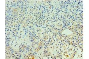 Immunohistochemistry of paraffin-embedded human breast cancer using ABIN7147302 at dilution of 1:100 (CDC16 抗体  (AA 371-620))