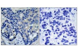 Immunohistochemical analysis of paraffin-embedded human breast carcinoma tissue using Pyk2(Phospho-Tyr402) Antibody(left) or the same antibody preincubated with blocking peptide(right). (PTK2B 抗体  (pTyr402))
