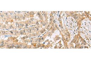 Immunohistochemistry of paraffin-embedded Human thyroid cancer tissue using HBZ Polyclonal Antibody at dilution of 1:120(x200) (HBZ 抗体)