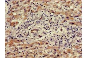 Immunohistochemistry of paraffin-embedded human liver cancer using ABIN7175730 at dilution of 1:100