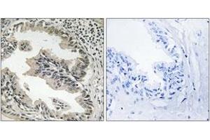 Immunohistochemistry analysis of paraffin-embedded human prostate carcinoma tissue, using SH3GLB2 Antibody. (SH3GLB2 抗体  (AA 131-180))
