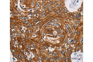 Immunohistochemistry of Human liver cancer using GRIN1 Polyclonal Antibody at dilution of 1:45 (GRIN1/NMDAR1 抗体)