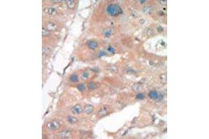 Formalin-fixed and paraffin-embedded human cancer tissue reacted with the primary antibody, which was peroxidase-conjugated to the secondary antibody, followed by DAB staining. (p21 抗体  (C-Term))