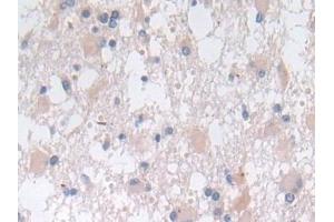 Detection of SNX13 in Human Glioma Tissue using Polyclonal Antibody to Sorting Nexin 13 (SNX13) (SNX13 抗体  (AA 97-284))