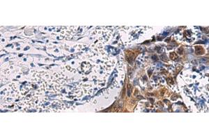 Immunohistochemistry of paraffin-embedded Human esophagus cancer tissue using SORD Polyclonal Antibody at dilution of 1:45(x200) (SORD 抗体)