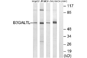 Immunohistochemistry analysis of paraffin-embedded human liver carcinoma tissue using B3GALTL antibody. (B3GALTL 抗体)