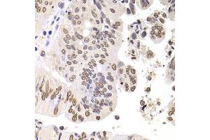 Immunohistochemistry of paraffin-embedded human colon carcinoma using SOX5 antibody at dilution of 1:100 (x400 lens). (SOX5 抗体)