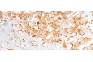 Immunohistochemistry of paraffin-embedded Human colorectal cancer tissue using MOB1B Polyclonal Antibody at dilution of 1:25(x200) (MOBKL1A 抗体)