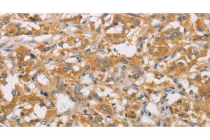 Immunohistochemistry of paraffin-embedded Human thyroid cancer using ARHGEF7 Polyclonal Antibody at dilution of 1:40 (ARHGEF7 抗体)