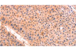 Immunohistochemistry of paraffin-embedded Human liver cancer tissue using LEP Polyclonal Antibody at dilution 1:30 (Leptin 抗体)
