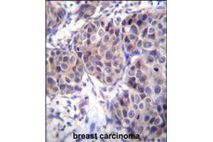 DVL3 Antibody immunohistochemistry analysis in formalin fixed and paraffin embedded human breast carcinoma followed by peroxidase conjugation of the secondary antibody and DAB staining. (DVL3 抗体  (C-Term))