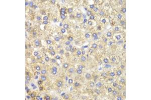 Immunohistochemistry of paraffin-embedded human liver cancer using HADH antibody (ABIN5970434) at dilution of 1/100 (40x lens). (HADH 抗体)