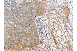 The image on the left is immunohistochemistry of paraffin-embedded Human cervical cancer tissue using ABIN7128369(ALPI Antibody) at dilution 1/25, on the right is treated with fusion protein. (Intestinal Alkaline Phosphatase 抗体)