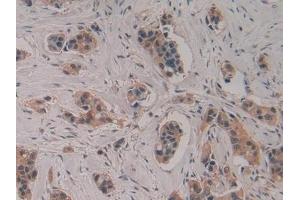 Detection of CASP4 in Human Breast cancer Tissue using Polyclonal Antibody to Caspase 4 (CASP4) (Caspase 4 抗体  (AA 290-377))