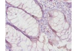 Immunohistochemistry of paraffin-embedded human colon cancer using ABIN7159497 at dilution of 1:100 (TIMP4 抗体  (AA 31-224))